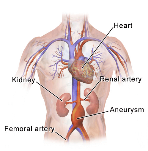 Aort Anevrizmaları