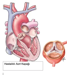 Sağlıklı Aort Kapağı