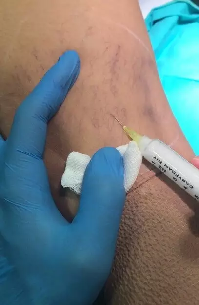 Köpük skleroterapi nedir
