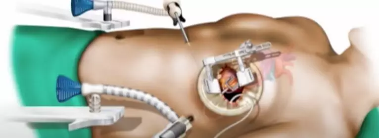 Meme Altı Kapalı Bypass ameliyatı nedir