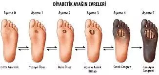 Nörotrofik (diyabetik) Ülserler