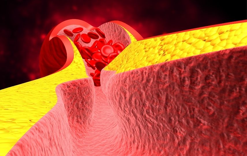 Pıhtı Atması (Emboli) Nedir? Nedenleri, Belirtileri Ve Tedavisi