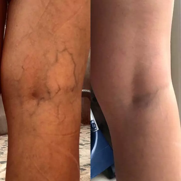 Skleroterapi nasıl yapılır