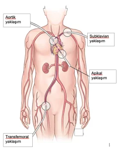 Transfemoral Yaklaşım