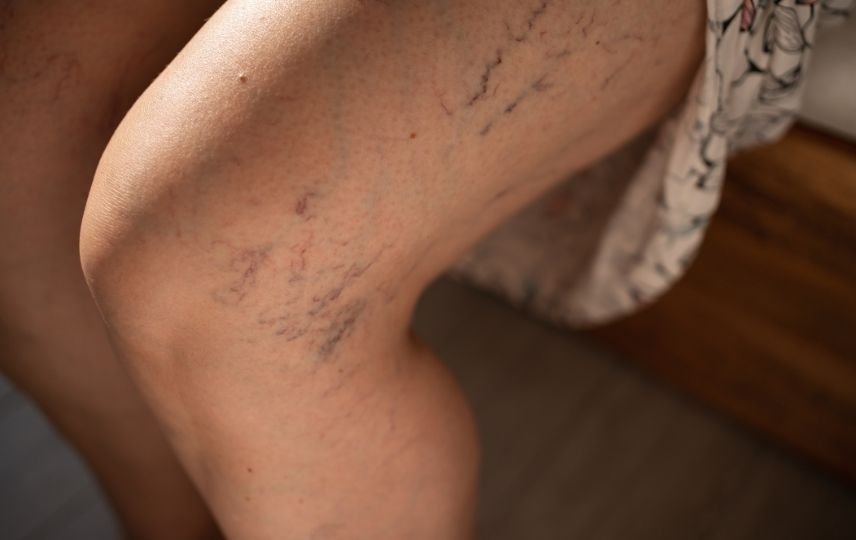 Varis ve Kılcal Damarların Tanı ve Tedavisi